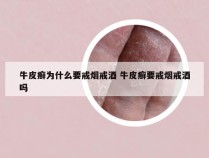 牛皮癣为什么要戒烟戒酒 牛皮癣要戒烟戒酒吗