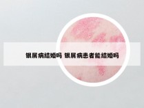 银屑病结婚吗 银屑病患者能结婚吗