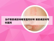 治疗银屑病深圳哪家医院好啊 银屑病深圳专科医院