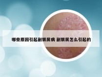 哪些原因引起副银屑病 副银屑怎么引起的