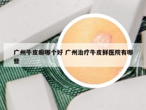 广州牛皮癣哪个好 广州治疗牛皮鲜医院有哪些