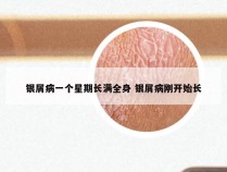银屑病一个星期长满全身 银屑病刚开始长