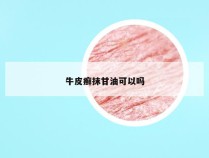 牛皮癣抹甘油可以吗
