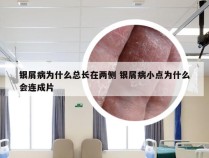 银屑病为什么总长在两侧 银屑病小点为什么会连成片