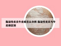 脂溢性皮炎牛皮癣怎么分辨 脂溢性皮炎与牛皮癣区别