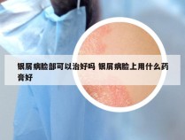 银屑病脸部可以治好吗 银屑病脸上用什么药膏好