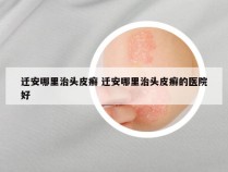 迁安哪里治头皮癣 迁安哪里治头皮癣的医院好