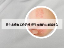 得牛皮癣有工作的吗 得牛皮癣的人能活多久