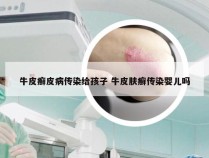 牛皮癣皮病传染给孩子 牛皮肤癣传染婴儿吗