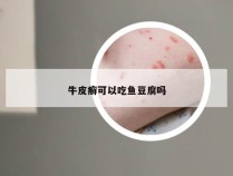 牛皮癣可以吃鱼豆腐吗