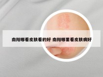 南阳哪看皮肤看的好 南阳哪里看皮肤病好