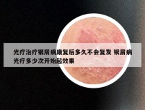 光疗治疗银屑病康复后多久不会复发 银屑病光疗多少次开始起效果