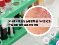 308准分子激光治疗银屑病 308激光治疗仪治疗银屑病几次有效果