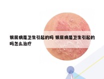 银屑病是卫生引起的吗 银屑病是卫生引起的吗怎么治疗