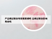 户尘螨过敏会导致银屑病吗 尘螨过敏会影响寿命吗