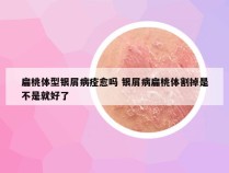 扁桃体型银屑病痊愈吗 银屑病扁桃体割掉是不是就好了