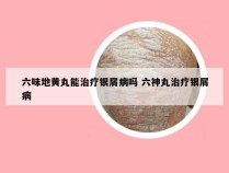 六味地黄丸能治疗银屑病吗 六神丸治疗银屑病