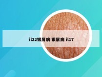 il22银屑病 银屑病 il17