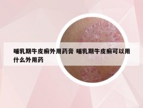 哺乳期牛皮癣外用药膏 哺乳期牛皮癣可以用什么外用药