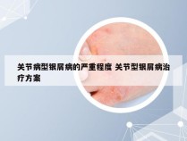 关节病型银屑病的严重程度 关节型银屑病治疗方案