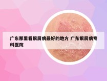 广东那里看银屑病最好的地方 广东银屑病专科医院