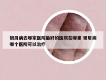 银屑病去哪家医院最好的医院在哪里 银屑病哪个医院可以治疗