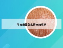 牛皮癣是怎么得来的呢啊