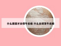 什么原因才会得牛皮癣 什么会诱发牛皮癣
