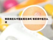 银屑病舌头中医能看出来吗 银屑病中医怎么说