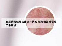 银屑病发暗后又出现一片红 银屑病最后变成了小红点
