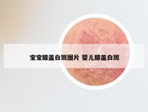 宝宝膝盖白斑图片 婴儿膝盖白斑