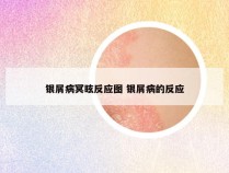 银屑病冥眩反应图 银屑病的反应