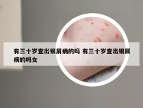 有三十岁查出银屑病的吗 有三十岁查出银屑病的吗女