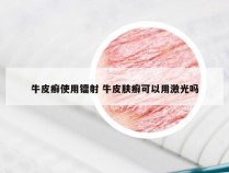 牛皮癣使用镭射 牛皮肤癣可以用激光吗