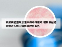 银屑病起透明水泡不疼不痒很红 银屑病起透明水泡不疼不痒很红肿怎么办