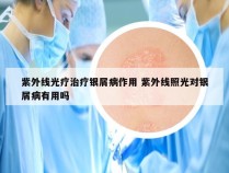 紫外线光疗治疗银屑病作用 紫外线照光对银屑病有用吗