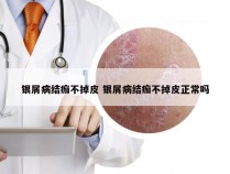 银屑病结痂不掉皮 银屑病结痂不掉皮正常吗