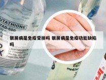 银屑病是免疫受损吗 银屑病是免疫功能缺陷吗