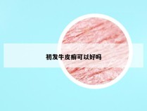 初发牛皮癣可以好吗