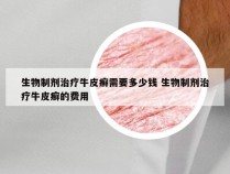 生物制剂治疗牛皮癣需要多少钱 生物制剂治疗牛皮癣的费用