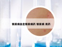 银屑病自愈银屑病药 银屑病 用药
