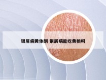 银屑病黄体酮 银屑病能吃黄桃吗