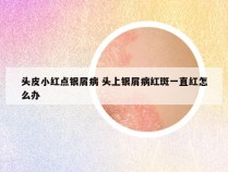 头皮小红点银屑病 头上银屑病红斑一直红怎么办
