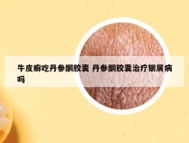 牛皮癣吃丹参酮胶囊 丹参酮胶囊治疗银屑病吗