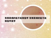 有银屑病的能不能做指甲 有银屑病的能不能做指甲美甲