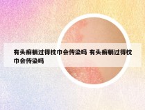 有头癣躺过得枕巾会传染吗 有头癣躺过得枕巾会传染吗