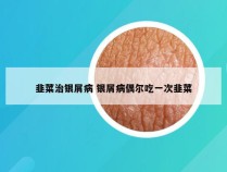 韭菜治银屑病 银屑病偶尔吃一次韭菜