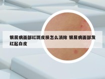 银屑病面部红斑皮损怎么消除 银屑病面部发红起白皮