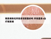 银屑病有吃环孢素软胶囊的吗 环孢菌素a治疗银屑病