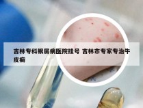 吉林专科银屑病医院挂号 吉林市专家专治牛皮癣
